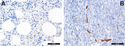 Tumor Microenvironment in Acute Myeloid Leukemia: Adjusting Niches